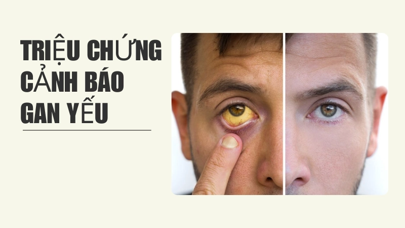 Biểu hiện vàng mắt là dấu hiệu điển hình khi chức năng gan suy giảm