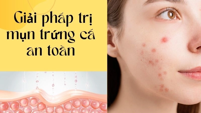 Hiểu đúng nguyên nhân mụn để trị tận gốc mà không kích ứng