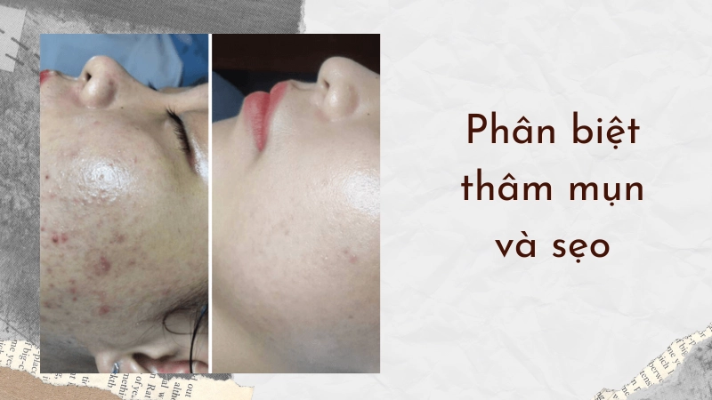Phân biệt rõ tình trạng da giúp trị thâm mụn lâu năm hiệu quả